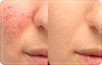 Zen Balance - ACNÉ Y SECUELA DE ACNÉ