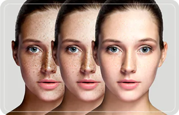 Zen Balance - HIPERCROMÍAS O MANCHAS