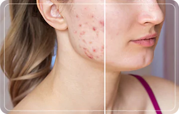 Zen Balance - PICOSURE