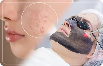 Zen Balance - PICOSURE + HOLLYWOOD PEEL